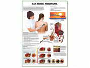 Рак кожи меланома плакат глянцевый  А1/А2 (глянцевый A1)