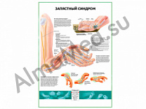 Запястный синдром плакат ламинированный А1/А2 (ламинированный A2)