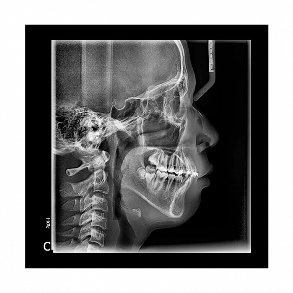 Pax-i 3D - панорамный аппарат и конусно-лучевой томограф, FOV 17x15 см | Vatech