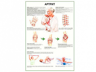 Артрит - плакат глянцевый А1/А2 (глянцевый A2)