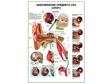 Заболевания среднего уха (отит) плакат глянцевый А1/А2 (глянцевый A2)