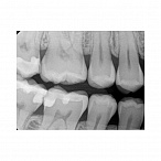 Carestream Dental RVG 6200 - радиовизиограф, 24 пар линий/мм