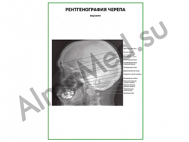 Рентгенография черепа. Вид сбоку плакат ламинированный А1/А2 (ламинированный	A2)