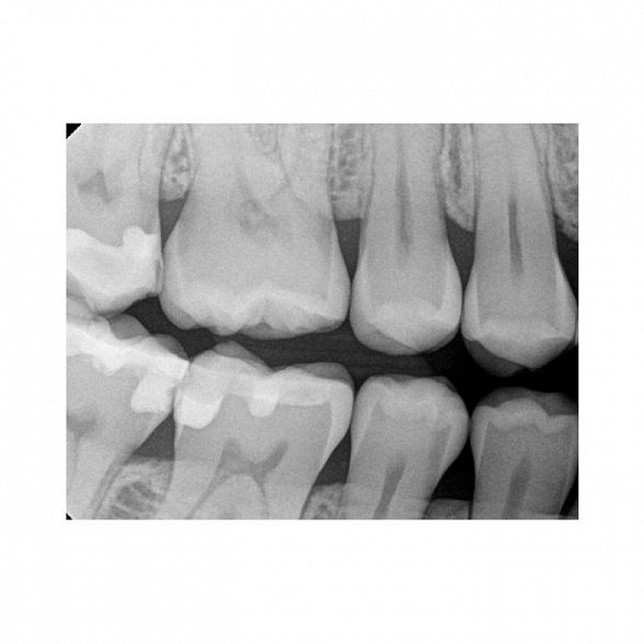 Carestream Dental RVG 6200 - радиовизиограф, 24 пар линий/мм