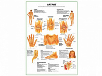 Артрит суставов плакат глянцевый А1/А2 (глянцевый A2)