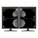 AI-платформа для анализа маммограмм ТриоДМ-МТ