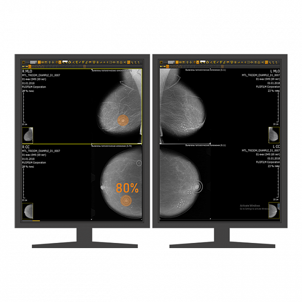 AI-платформа для анализа маммограмм ТриоДМ-МТ