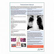 Пневмококковая инфекция медицинский плакат А1+/A2+ (глянцевая фотобумага от 200 г/кв.м, размер A2+)