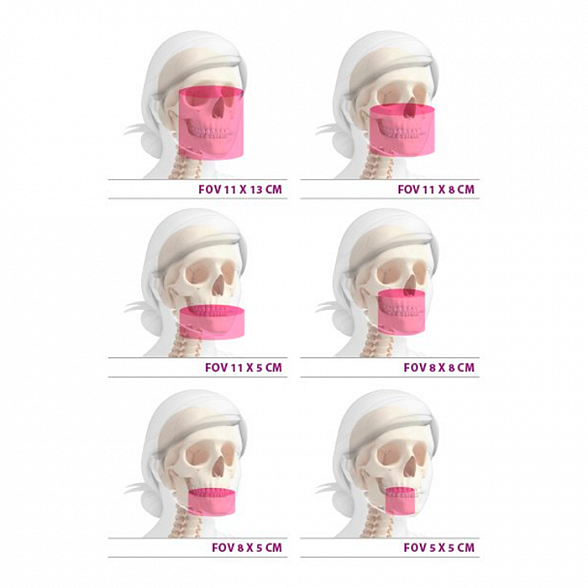 MyRay Hyperion X9 CB3D 11x13 Ceph Titanium - дентальный цифровой 3D-томограф с цефалостатом, 3 в 1, FOV 11x13