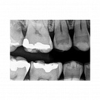 Carestream Dental RVG 5200 - радиовизиограф, 16 пар линий/мм