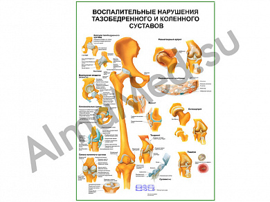 Воспалительные нарушения тазобедренного и коленного суставов плакат глянцевый/ламинированный А1/А2 (глянцевый A2)