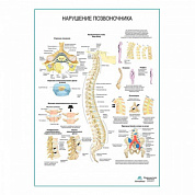 Нарушения позвоночника плакат глянцевый А1+/А2+ (глянцевый холст от 200 г/кв.м, размер A1+)