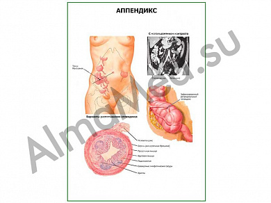 Аппендикс плакат ламинированный А1/А2 (ламинированный	A2)