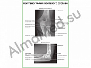 Рентгенография локтевого сустава плакат ламинированный А1/А2 (ламинированный	A2)