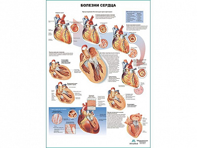 Болезни сердца, плакат глянцевый А1/А2 (глянцевый A1)
