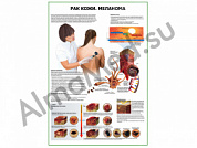 Рак кожи меланома плакат глянцевый/ламинированный А1/А2 (глянцевый A2)