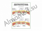 Влагалище прямой мыщцы живота. Поперечное сечение плакат глянцевый/ламинированный А1/А2 (глянцевый	A2)