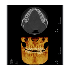 RAYSCAN Symphony Alpha OCS – ортопантомограф c цефалостатом (One Shot), 30х25 см
