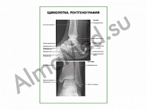 Щиколотка. Рентгенография плакат ламинированный А1/А2 (ламинированный	A2)