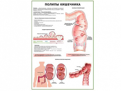 Полипы кишечника плакат глянцевый  А1/А2 (глянцевый A1)