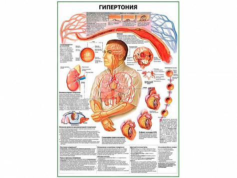 Гипертония плакат глянцевый А1/А2 (глянцевый A1)