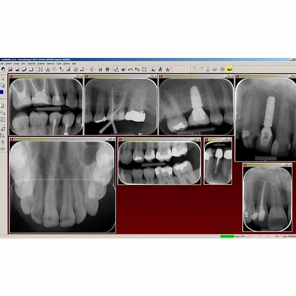 Digora Optime Classic - беспроводной визиограф в комплекте с 6-ю тонкими датчиками размера 31x41 мм