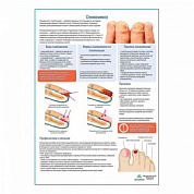 Онихомикоз медицинский плакат А1+/A2+ (глянцевая фотобумага от 200 г/кв.м, размер A2+)