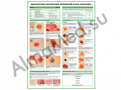 Меланома, диагностика, плакат ламинированный А1/А2 (ламинированный	A2)