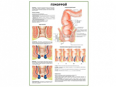 Геморрой плакат глянцевый А1/А2 (глянцевый A2)