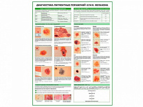 Меланома, диагностика, плакат глянцевый А1/А2 (глянцевый A1)