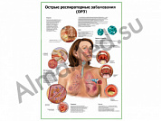 Острые респираторные заболевания плакат глянцевый/ламинированный А1/А2 (глянцевый A2)