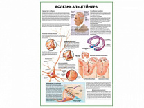 Болезнь Альцгеймера плакат глянцевый А1/А2 (глянцевый A1)