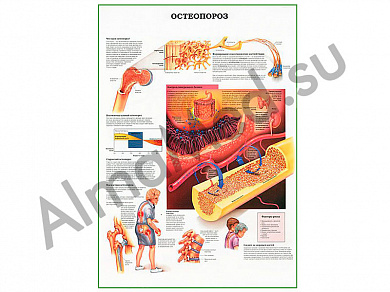 Остеопороз плакат ламинированный А1/А2 (ламинированный A2)
