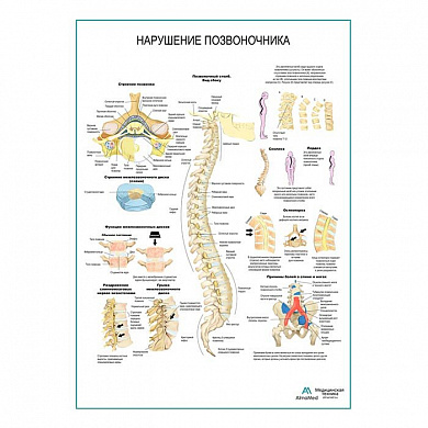 Нарушения позвоночника плакат глянцевый А1+/А2+ (матовый холст от 200 г/кв.м, размер A1+)