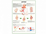 Артрит - плакат глянцевый А1/А2 (глянцевый A1)