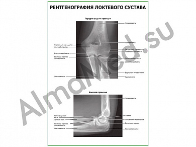 Рентгенография локтевого сустава плакат ламинированный А1/А2 (ламинированный	A2)