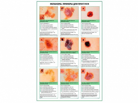 Меланома, примеры для практики, плакат глянцевый А1/А2 (глянцевый A1)