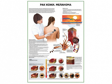 Рак кожи меланома плакат глянцевый  А1/А2 (глянцевый A2)