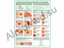 Меланома, диагностика, плакат ламинированный А1/А2 (ламинированный	A2)