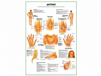 Артрит суставов плакат глянцевый А1/А2 (глянцевый A1)