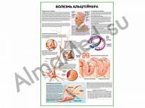 Болезнь Альцгеймера плакат ламинированный А1/А2 (ламинированный A2)