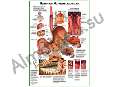 Язвенная болезнь желудка плакат ламинированный А1/А2 (ламинированный A2)