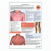 Лихорадка Денге медицинский плакат А1+/A2+ (глянцевый холст от 200 г/кв.м, размер A1+)
