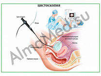 Цистоскопия, плакат ламинированный А1/А2 (ламинированный	A2)