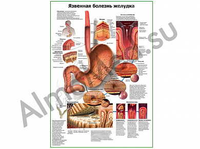 Язвенная болезнь желудка плакат глянцевый/ламинированный А1/А2 (глянцевый A2)