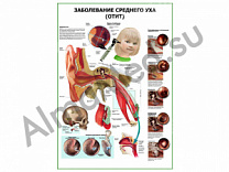 Заболевания среднего уха (отит) плакат ламинированный А1/А2 (ламинированный A2)