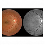 Томограф спектральный оптический когерентный, вариант исполнения: НОСТ-1, HUVITZ