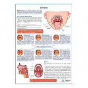 Ангина медицинский плакат А1+/A2+ (матовый холст от 200 г/кв.м, размер A1+)
