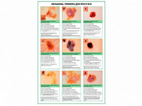 Меланома, примеры для практики, плакат глянцевый А1/А2 (глянцевый A2)