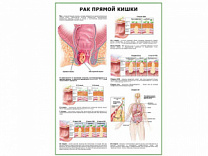 Рак прямой кишки плакат глянцевый  А1/А2 (глянцевый A2)